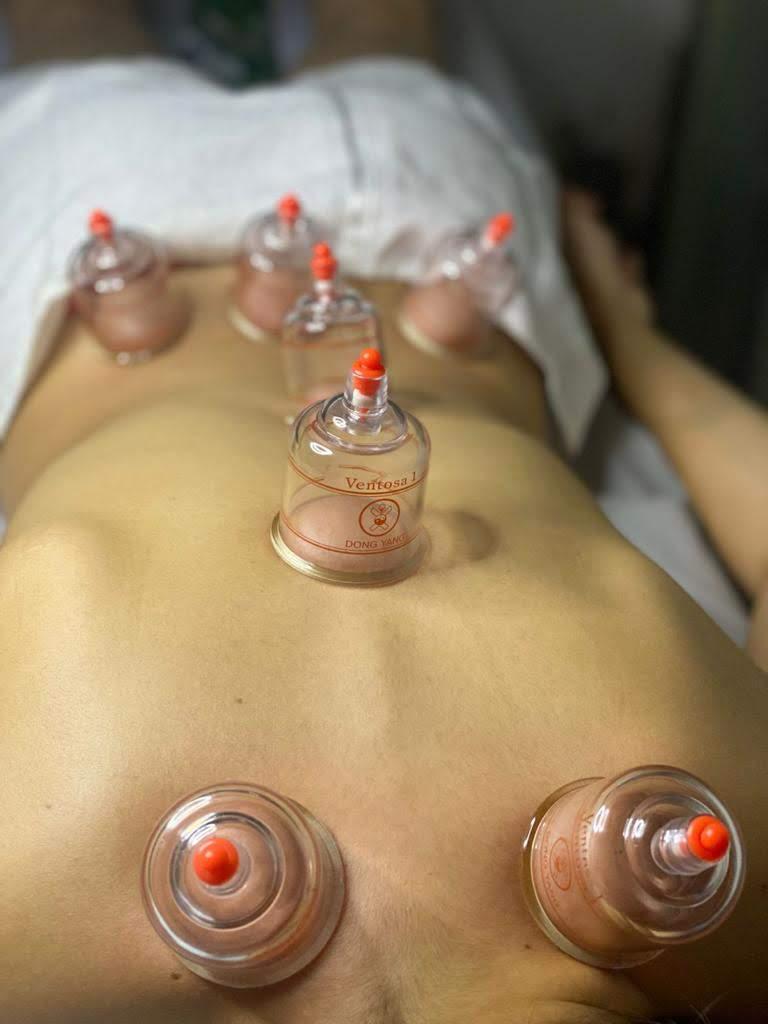 Foto real de ventosaterapia, uma das técnicas oferecidas